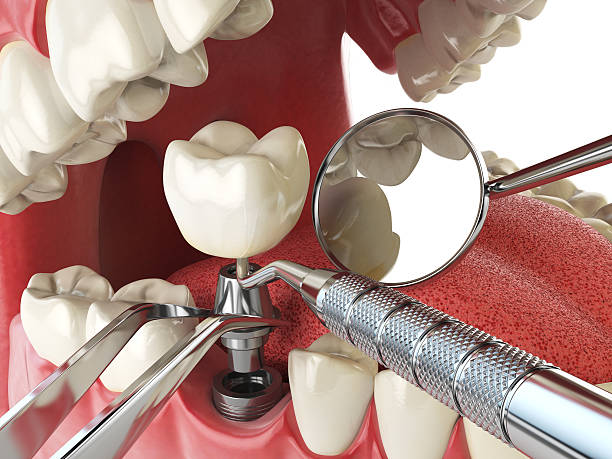 Best Urgent Care for Lost Fillings or Crowns in Lakeport, CA